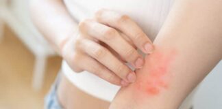 Caso di scabbia in una scuola di Bordighera: il Comune ordina la pulizia di aree esterne agli istituti e parchi giochi scabbia